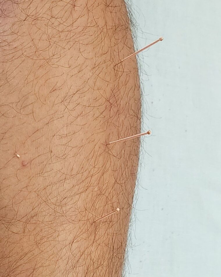Agujas de acupuntura colocadas en la pierna durante un tratamiento en el consultorio de Villa del Parque